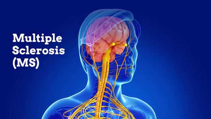 منشا بیماری MS چیست؟! 3 شایع ترین علایم بیماری MS | مجله سلامتی تک آشپز