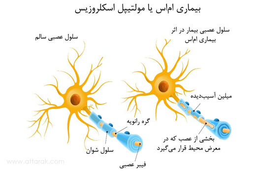 منشا بیماری MS چیست؟! 1 ام اس (MS) چیست ؟| مجله سلامتی تک آشپز