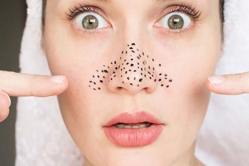 چگونه جوش های سر سیاه را از بین ببریم؟ 1 چگونه جوش های سر سیاه را از بین ببریم-مجله تک آَشپز