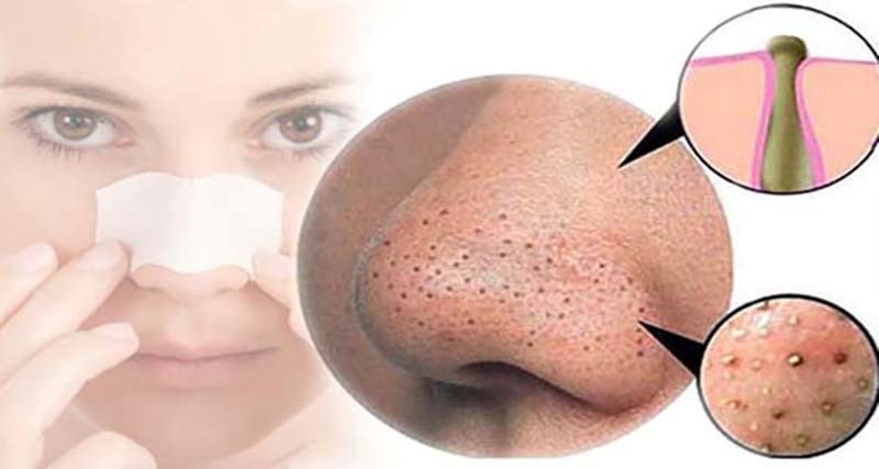 چگونه جوش های سر سیاه را از بین ببریم؟ 6 چگونه جوش های سر سیاه را از بین ببریم-مجله تک آَشپز