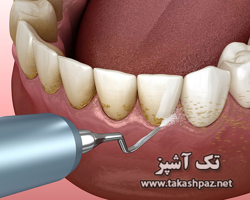10 راه برای سفید کردن دندان های زرد- مجله نک آشپز