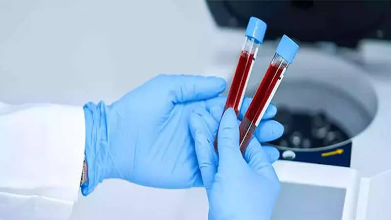نمونه گیری آزمایش قند خون در منزل 3 نمونهگیری آزمایش قند خون در منزل