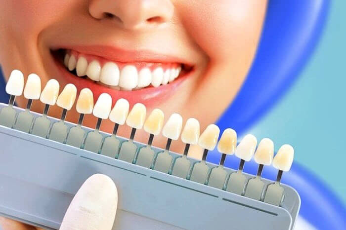 لمینت دندان چیست؟ انواع لمینت دندان و نحوه اجرای آن 1 انواع لمینت دندان