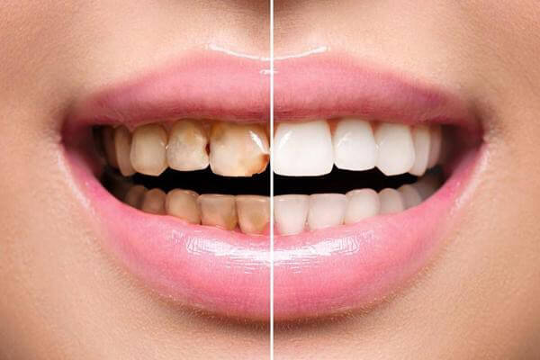لمینت دندان چیست؟ انواع لمینت دندان و نحوه اجرای آن 2 کاربرد لمینت چیست؟