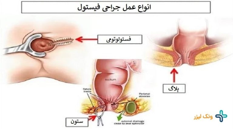 عمل جراحی فیستول