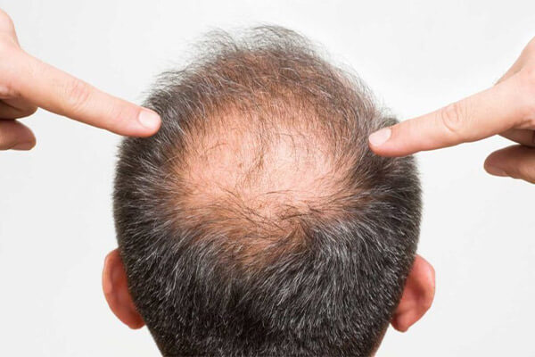 تاثیر هورمون‌ ها در سلامت مو