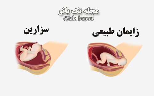 سزارین یا زایمان طبیعی | مجله بانوان تک آشپز